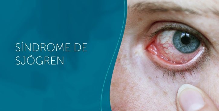 OLHO SECO NA SÍNDROME DE SJOGREN